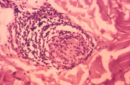 Hansen’s Disease (Leprosy; Mycobacterium leprae) Hansen’s Disease (Leprosy; Mycobacterium leprae)