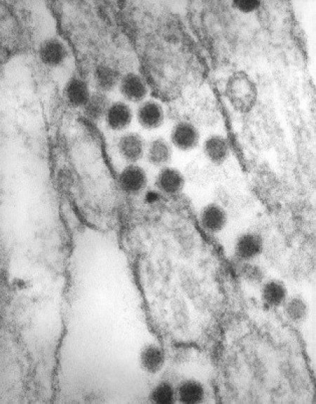 St. Louis Encephalitis St. Louis Encephalitis