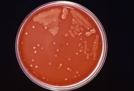 Toxic Shock Syndrome: Staphylococcal and Streptococcal Toxic Shock Syndrome: Staphylococcal and Streptococcal