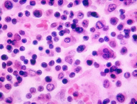 Typhoid Fever (Salmonella Typhi) Typhoid Fever (Salmonella Typhi)