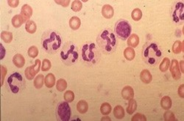 Ehrlichiosis Ehrlichiosis