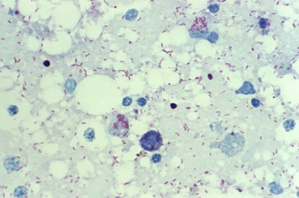 Spotted fever rickettsiosis