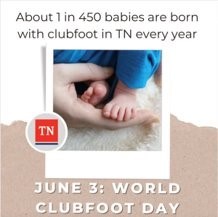 World Clubfoot Day World Clubfoot Day